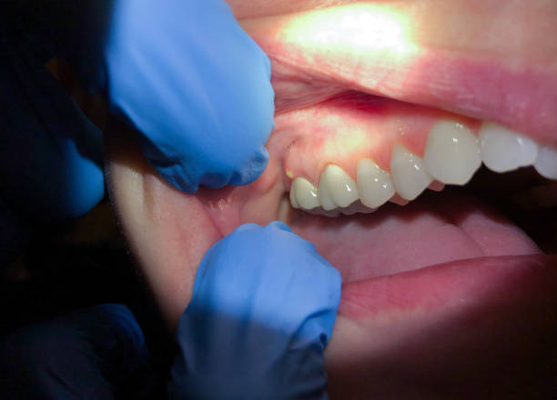 Best Emergency Dental Care for Broken or Chipped Teeth in South Point, OH
